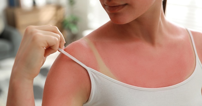 Frau mit Sonnenbrand © Shutterstock