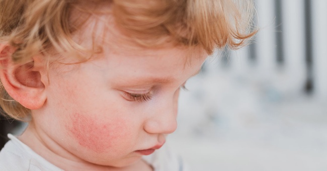 Bei etwa 30 % der Kinder entwickelt sich ein klassischer Krankheitsverlauf mit Schmetterlingsexanthem und ringelartigen Hautrötungen. © iStock/NatalyaStepowaya