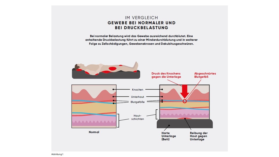 Gewebe bei normaler und bei Druckbelastung © Screenshot APOverlag