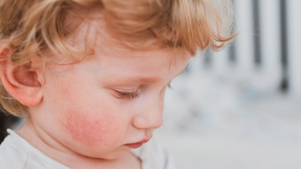 Bei etwa 30 % der Kinder entwickelt sich ein klassischer Krankheitsverlauf mit Schmetterlingsexanthem und ringelartigen Hautrötungen. © iStock/NatalyaStepowaya