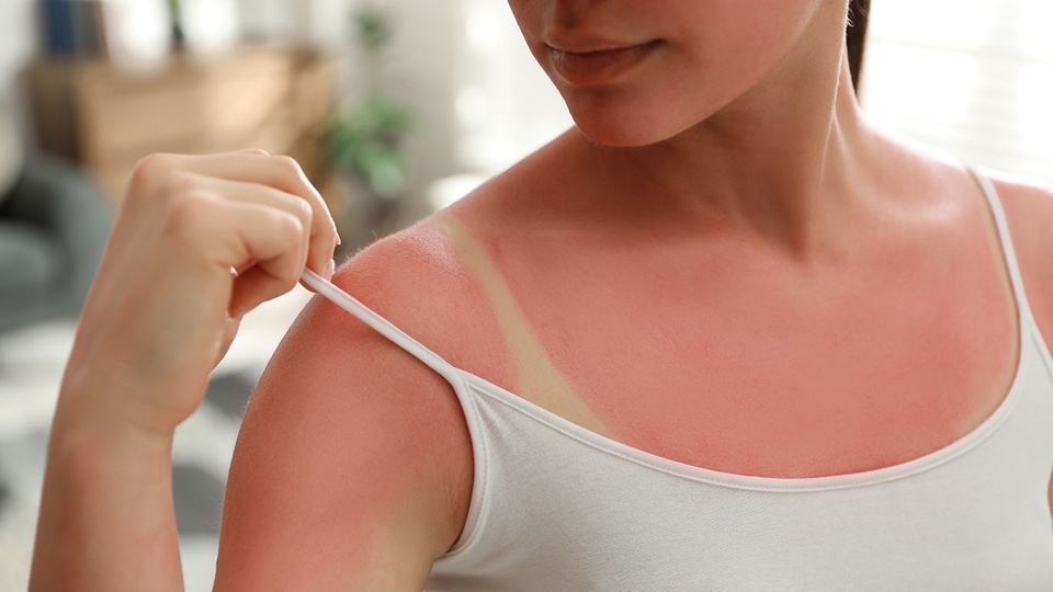 Frau begutachtet Sonnenbrand © Shutterstock